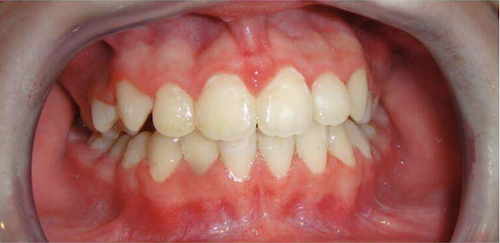Pred a Po výsledky ortodoncie Ortho Keep Smiling