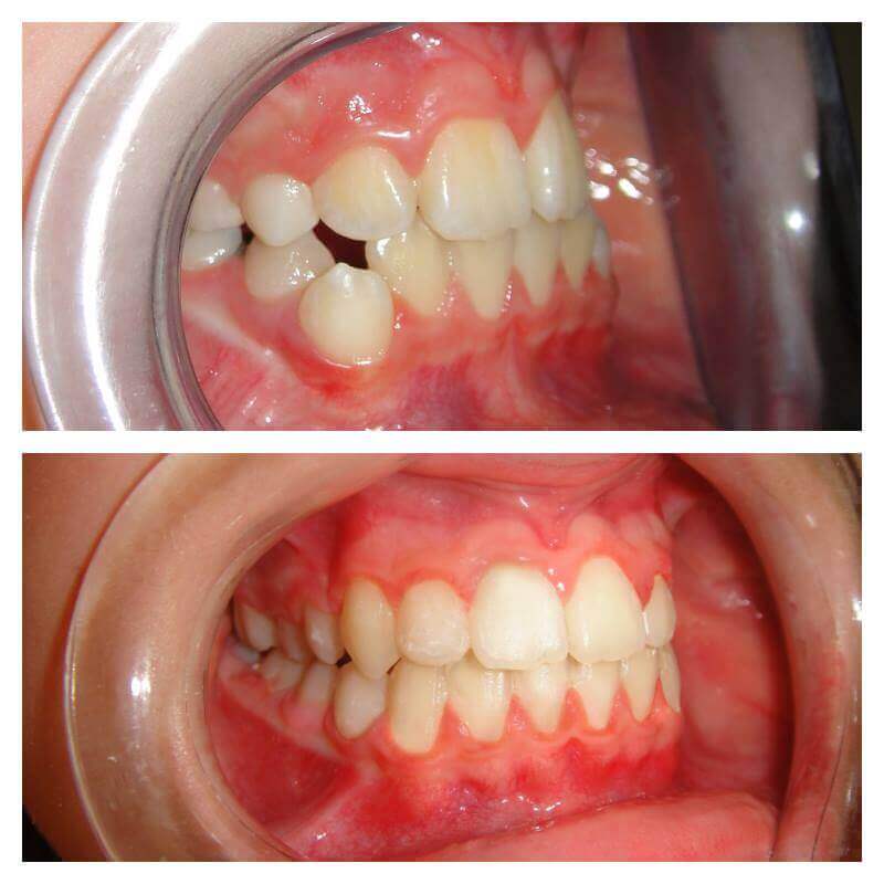 Ortodoncia a čeľustná ortopédia Ortho Keep Smiling Pred a Po