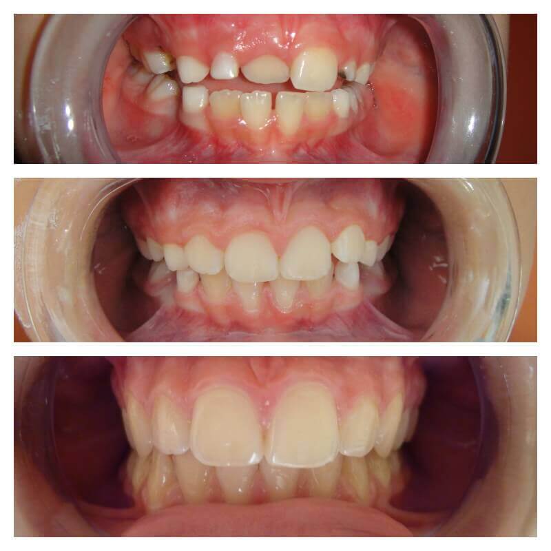 Ortodoncia a čeľustná ortopédia Ortho Keep Smiling Pred a Po